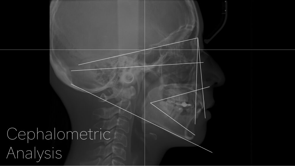 5.セファロ分析