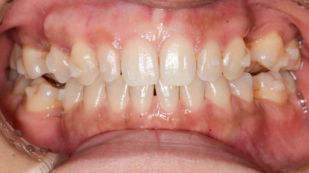 6.術前正面1年経過