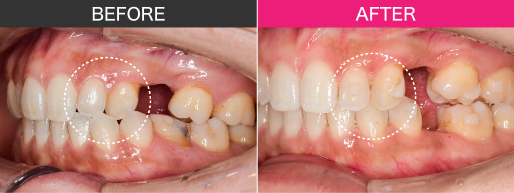 7.術前左1年経過比較