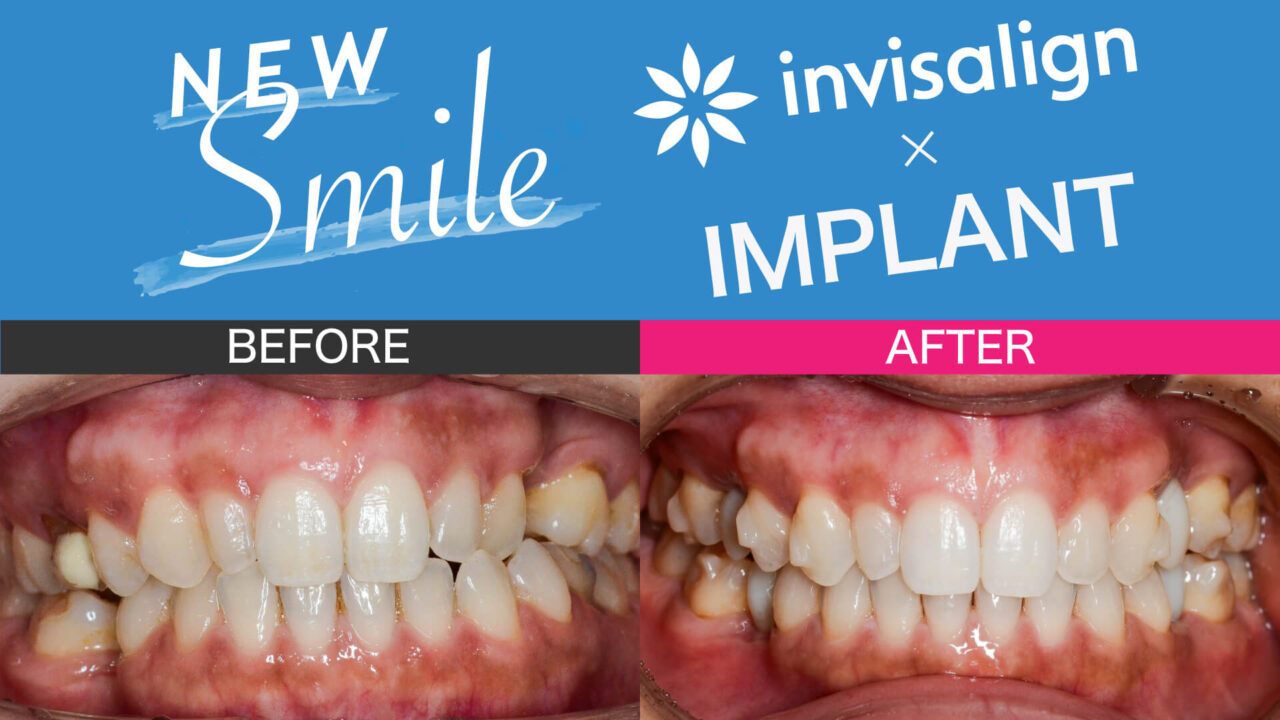 アイキャッチ画像invisa#2