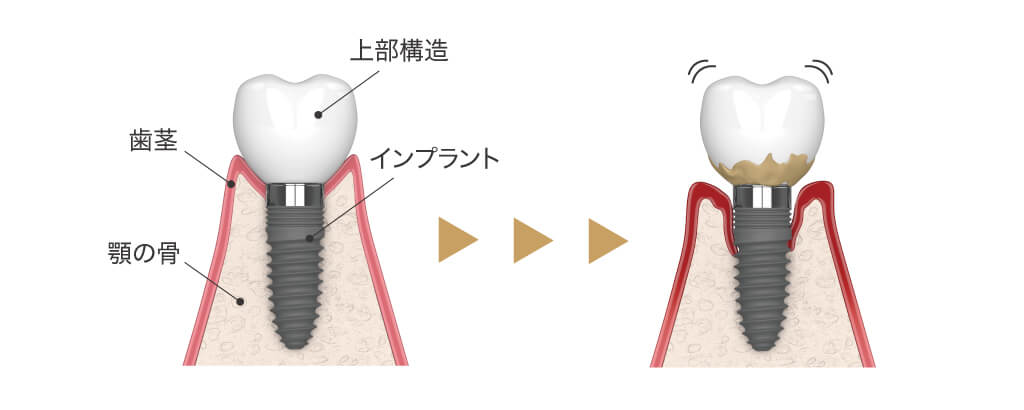 インプラント失敗